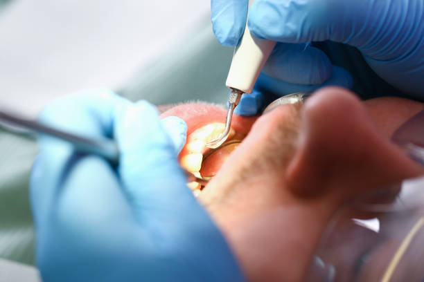 Best Emergency Root Canal Treatment in Jefferson City, MO